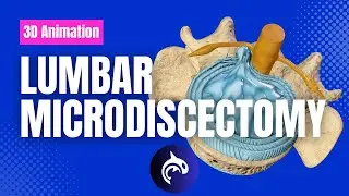 Lumbar Microdiscectomy - 3D Animation