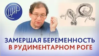 Рудиментарный рог матки. Что делать. если беременность замерла в рудиментарном роге матки? Гузов И.И