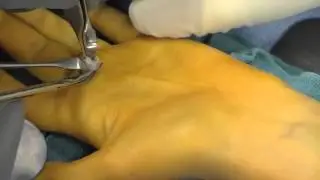 Ganglion Cyst of Tendon Sheath Surgery by Dr. Thomas Trumble