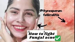 ✅ 5 WAYS TO GET RID OF FUNGAL ACNE EFFECTIVELY