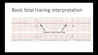 Interpreting Intrapartal fetal heart rate tracings