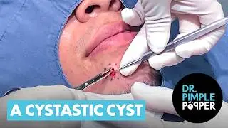 A Cystastic Cyst