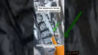 Большая грыжа в шее. Как ее вылечить. 
