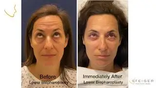 Lower Eyelid Surgery - Immediate Results-  Blepharolplasty for Under Eye Bags