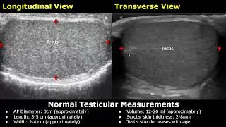 How To Measure Scrotum On Ultrasound | Testis, Epididymis AP Diameter, Length, Width & Volume USG