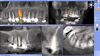 Implant Case #7 - Dr. Tarun Agarwal, Part 3: GALILEOS implant planning