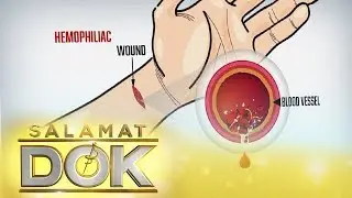 Hemophilia | Salamat Dok