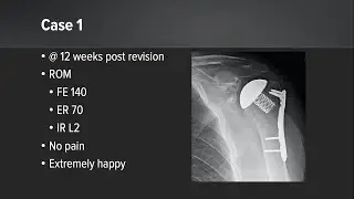 Eclipse™ Stemless Shoulder Arthroplasty System: Options for Care Following an ORIF