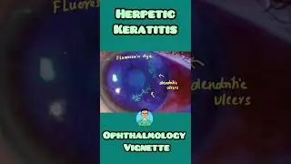 Herpetic Keratitis made simple for USMLE, NEET PG, NCLEX, INICET