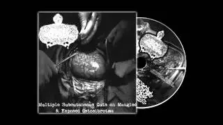 UxTxIxFxSxPxCx - Multiple Subcutaneous Cuts on Mangled & Exposed Ostosibrotma [2012]