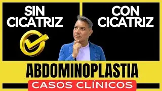 ⚠️ ABDOMINOPLASTIA SIN CICATRIZ ¡CASOS CLÍNICOS! ► Resultados Antes y Después Técnica Five Stars