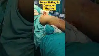 Femur Nailing in Operation Theature| Femur Bone Surgery | जांघ की हड्डी का आपरेशन | 