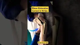 Fast 15 Sec Elbow Dislocation Correction🔥 कोहनी चढ़ाने की प्रक्रिया 🔥