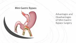 Advantages and Disadvantages of Mini Gastric Bypass Surgery