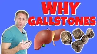 What Causes Gallstones and How to Treat Them