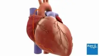 How coronary artery bypass graft (CABG) surgery is carried out | Bupa Health