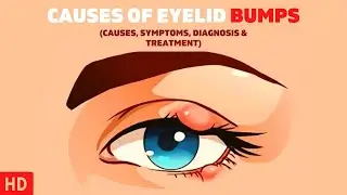 The Surprising Causes of Eyelid Bumps You Never Knew About!