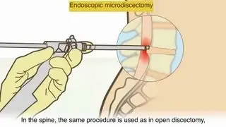 A herniated disc - What is it and what surgical treatments are available?