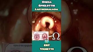 Omega Epiglottis in Laryngomalacia made easy for USMLE, NEET PG, INCET, NCLEX