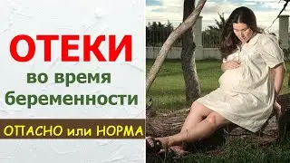 Отеки во время беременности. Опасность или норма