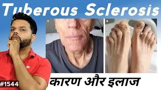 Tuberous Sclerosis Causes, Symptoms & Treatment In Hindi