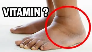 #1 Vitamin to Eliminate Swollen Feet and Legs