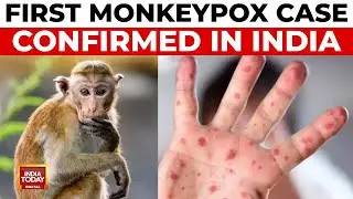 India Reports First Confirmed Monkeypox Case, Non-Emergency Variant Detected