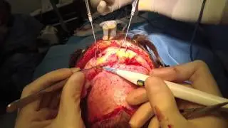 Live Surgery Open Forehead Lift / Brow lift (uncensored)
