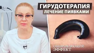 Лечение медицинскими пиявками (Гирудотерапия)