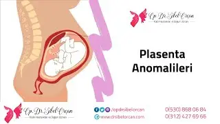 Plasenta Anomalileri - Op. Dr. Sibel Orçan