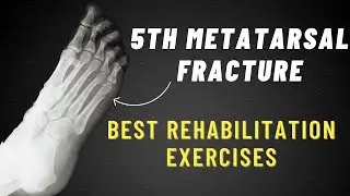 5th Metatarsal Fracture Exercises | 6 Week Program