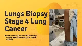 How to take Pleural Fluid Sample - Lungs Biopsy for Stage 4 Lungs Cancer Patient