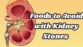 Foods to Avoid with Kidney Stones | Remedies for Kidney Stones.