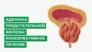 Аденома предстательной железы: консервативное лечение