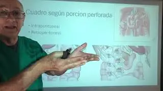 Perforación Duodenal. Signo Joubert. Neumoperitoneo signo de Popper en el Rx de tórax