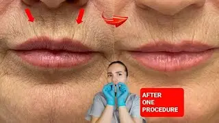 Quick massage for LIP LINES | Wrinkles around the lips