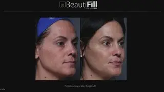 Learn more about BeautiFill, a fat transfer treatment available at Southside Dermatology (FCL Februa