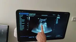 Пункция эхинококковой кисты печени под контролем УЗИ.