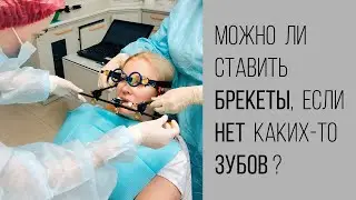 Исправление прикуса, если нет каких-то зубов. Как быть?