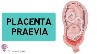 Placenta Praevia