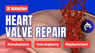 Understand Heart Valve Repair & Replacement: Annuloplasty, Valvuloplasty, and Valve Replacement