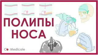 Полипы носа - что такое, причины, методы лечения - кратко