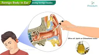 Foreign Body In The Ear 👂 : ENT Lectures