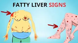 A Silent Threat: 8 Signs That Could Indicate Fatty Liver Disease | Healthy Care