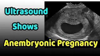 Ultrasound Shows Anembryonic Pregnancy