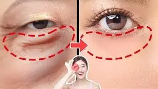 5mins  ANTI-AGING FACE EXERCISES FOR EYE BAGS, EYE WRINKLES, DARK CIRCLES UNDER EYES | No Surgery!