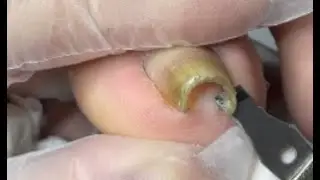 A Perfect nail cutting for super curved nail - Best Nail Skill Teaching by Mr Toenail