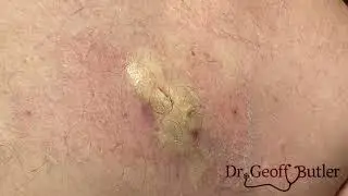 Drainage of an infected epidermal cyst