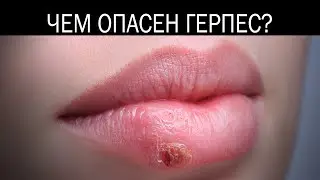 Чем опасен герпес