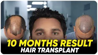 Hair Transplant in Chennai | Best Results & Cost of Hair Transplant in Chennai